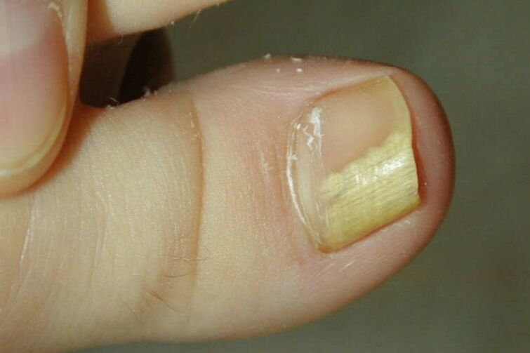 ayak başparmağında mantar belirtileri fotoğraf 1