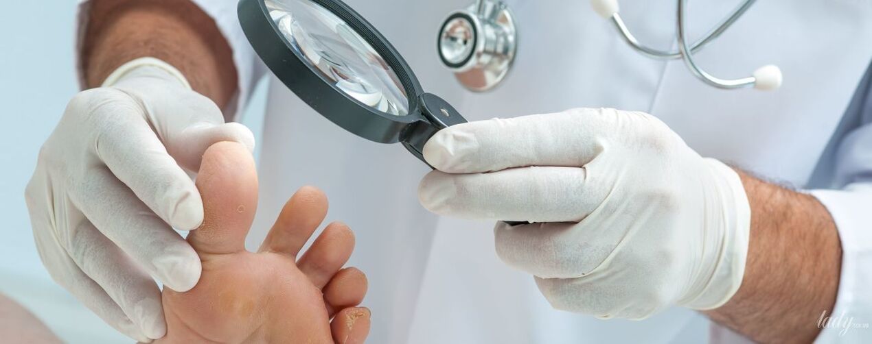 Doktor, mantarı ayak parmağında inceler