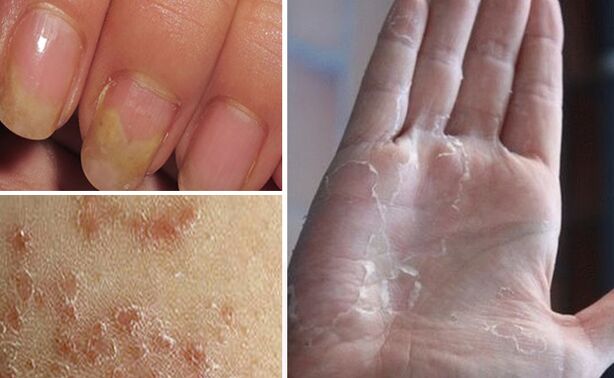 Mycosis vücudun diğer kısımlarına geçebilir mi