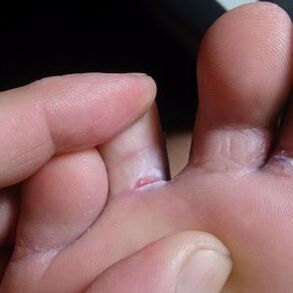 ayak parmakları arasında çatlak mantar semptomları
